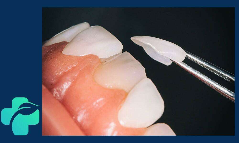 لمینت دندان