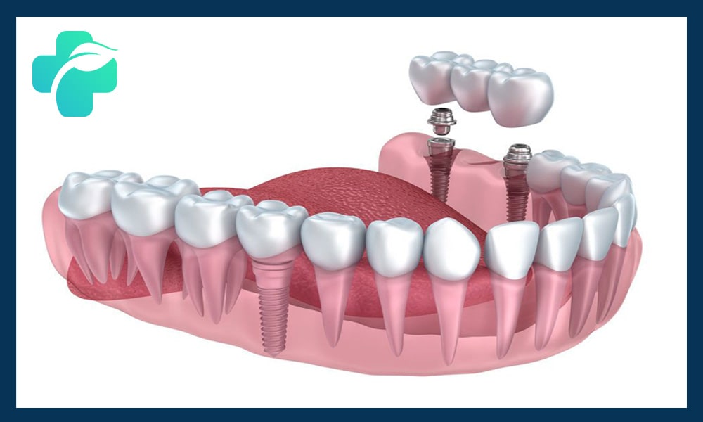 محدوده سنی ایمپلنت دندان