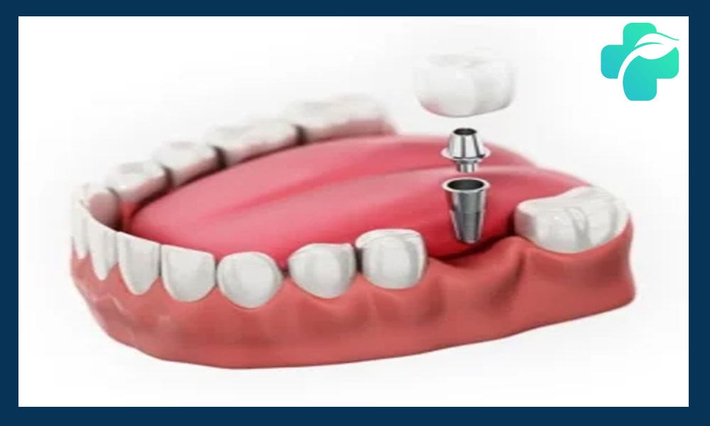 محدوده سنی ایمپلنت دندان