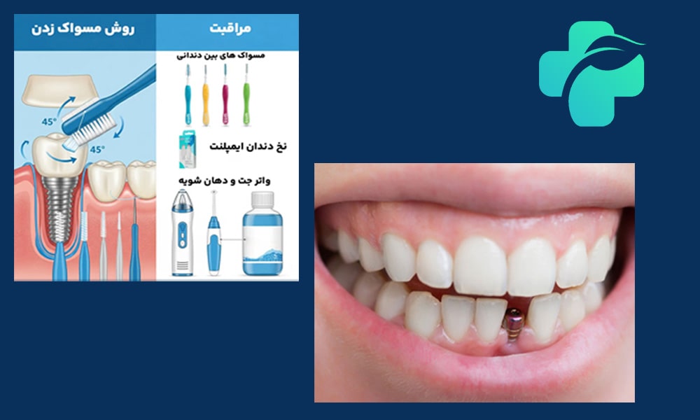 مراقبت های بعد از ایمپلنت دندان