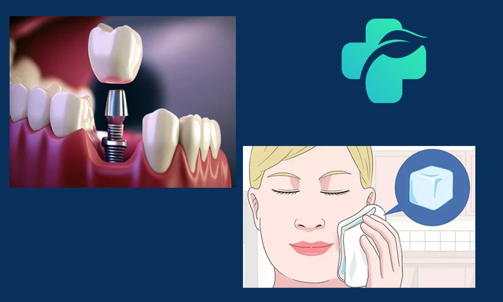 مراقبت های بعد از ایمپلنت دندان