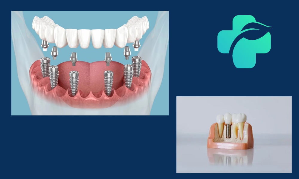 مراقبت های بعد از ایمپلنت دندان