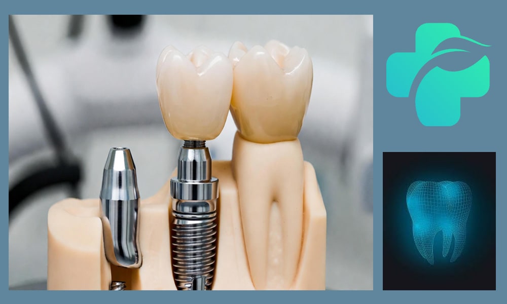 ایمپلنت دندان دیجیتال چیست؟