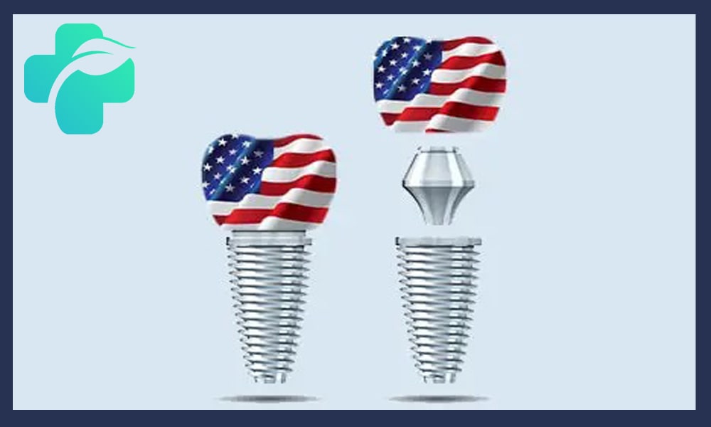 ایمپلنت آمریکایی