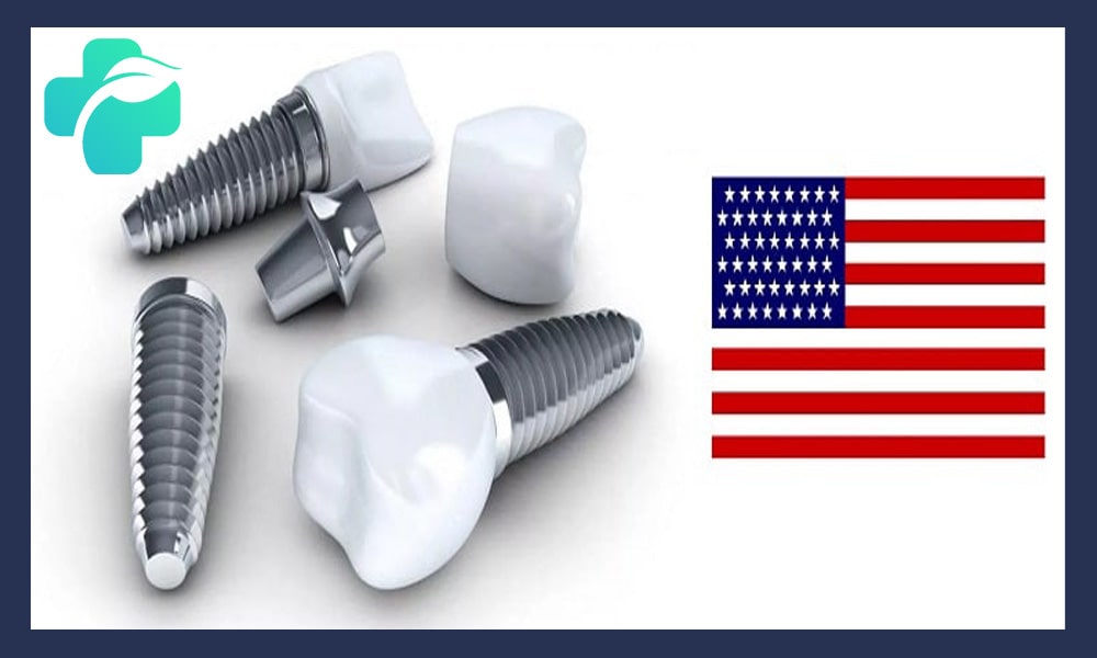 ایمپلنت آمریکایی