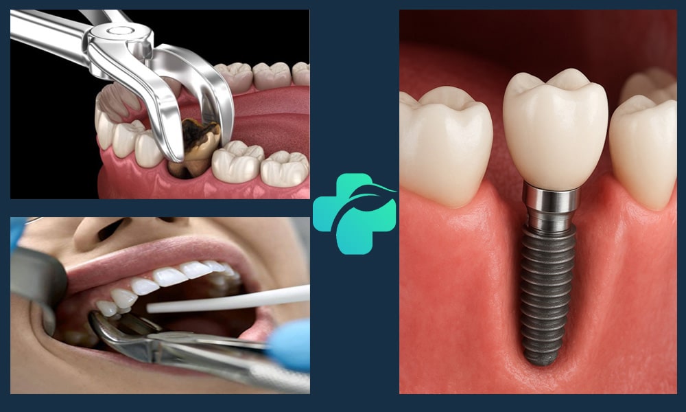 زمان کاشت ایمپلنت بعد از کشیدن دندان