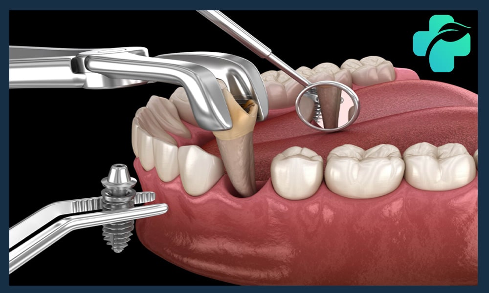 زمان کاشت ایمپلنت بعد از کشیدن دندان