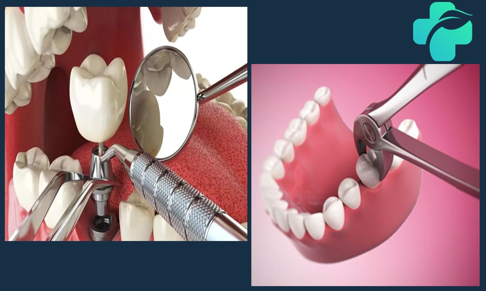 زمان کاشت ایمپلنت بعد از کشیدن دندان