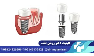 ایمپلنت چینی