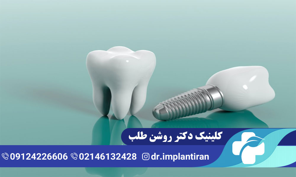 ایمپلنت چینی