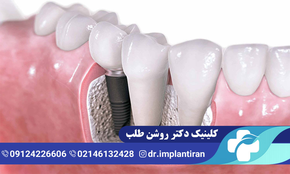 علائم عفونت ایمپلنت دندان و روش های درمان