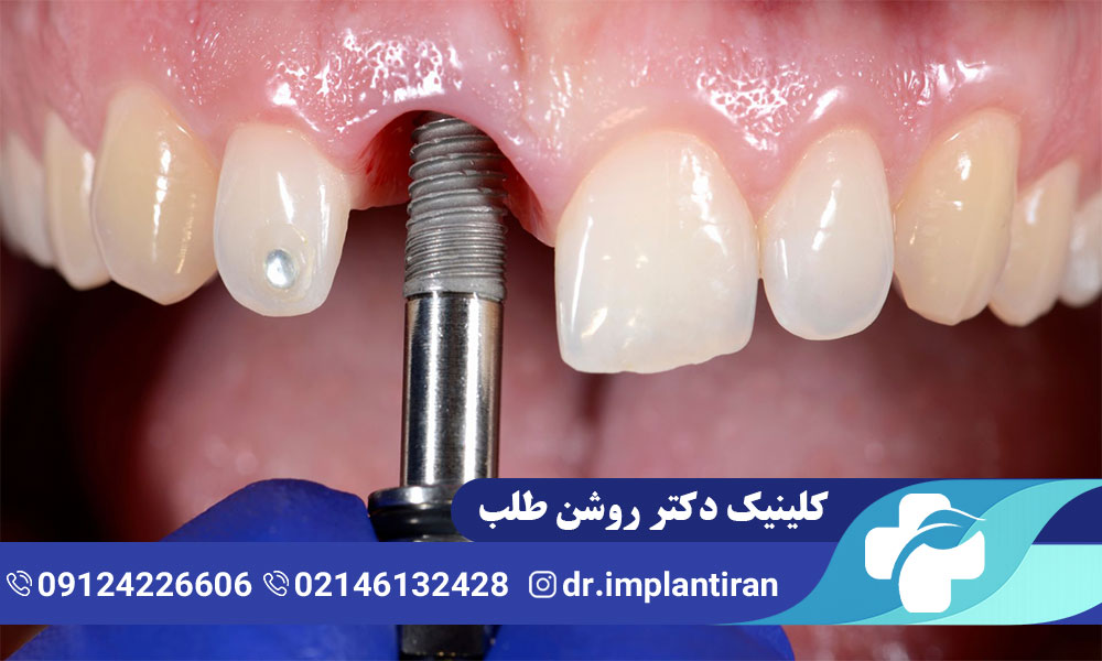 علائم عفونت ایمپلنت دندان و روش های درمان