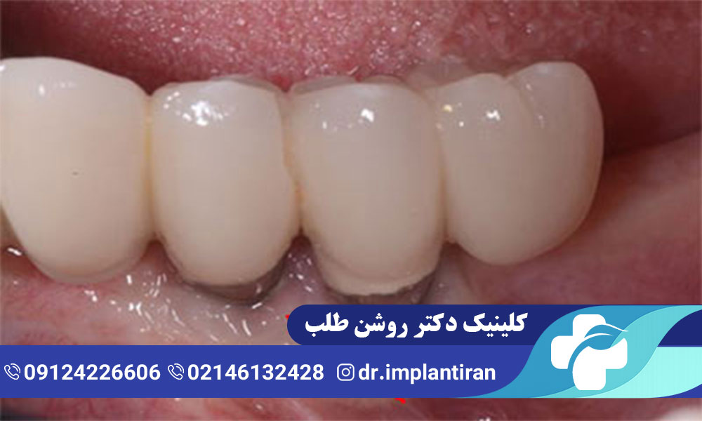 علائم عفونت ایمپلنت دندان و روش های درمان