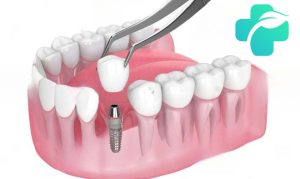 طول عمر ایمپلنت دندان
