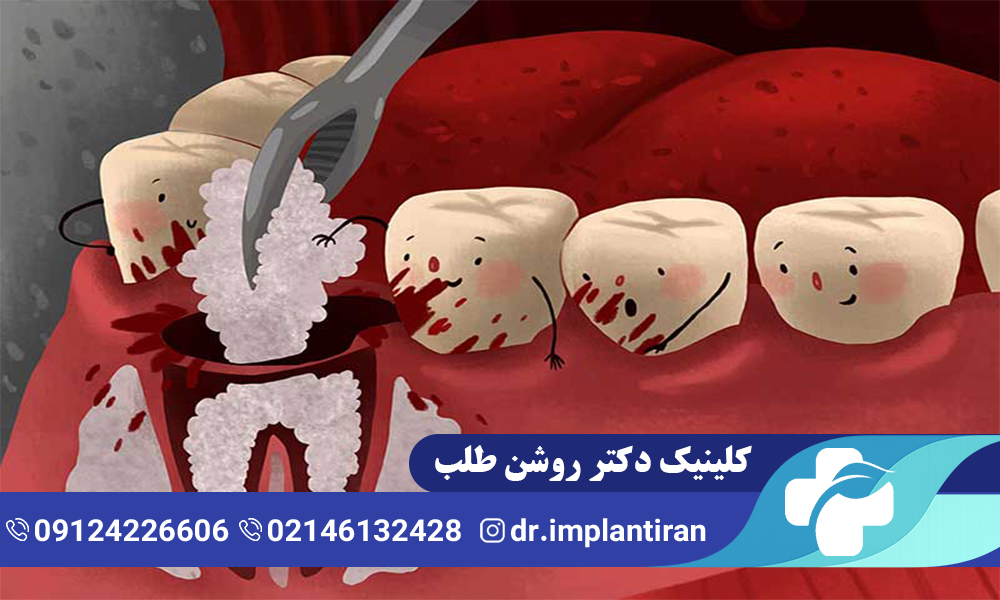 راه های درمان درد ایمپلنت دندان