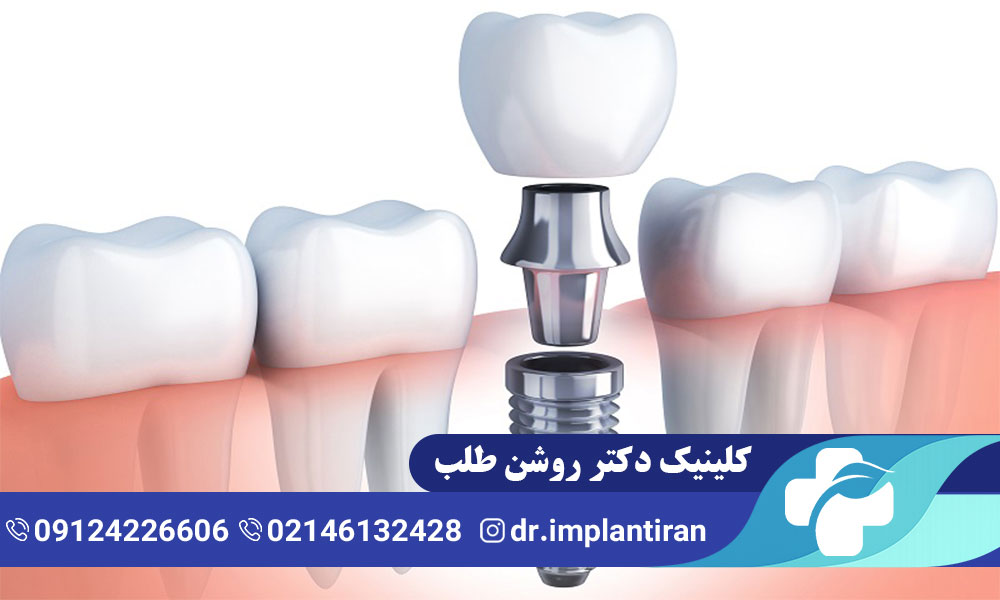 ایمپلنت دندان با بیهوشی