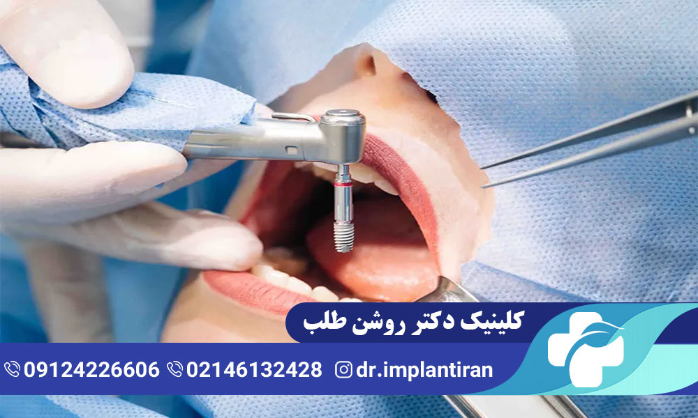 ایمپلنت دندان با بیهوشی
