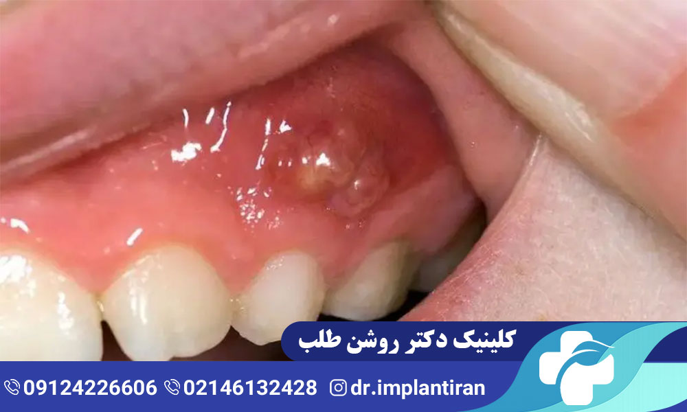 روش های درمان عفونت دندان کودکان