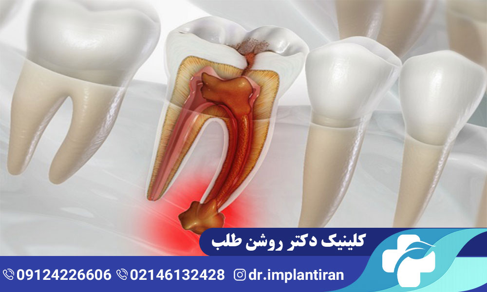 روش های درمان عفونت دندان کودکان