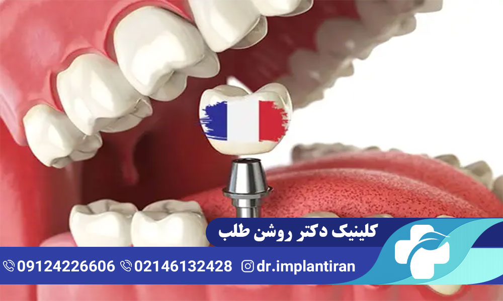 ایمپلنت فرانسوی