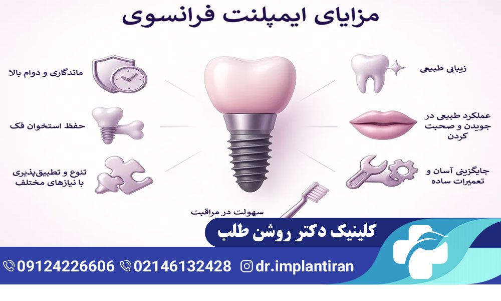 ایمپلنت فرانسوی