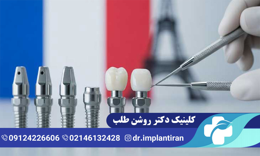 ایمپلنت فرانسوی