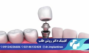 ایمپلنت فرانسوی