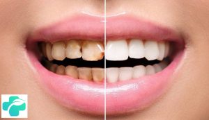 لمینت دندان شکسته جلو