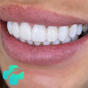 لمینت دندان شکسته جلو