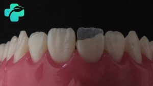 لمینت دندان شکسته جلو