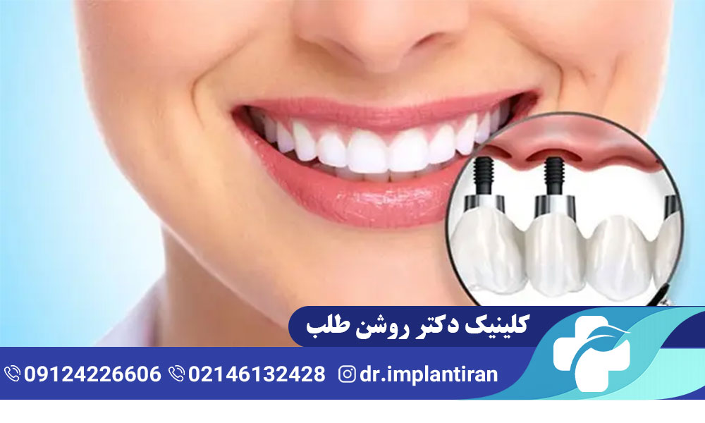 جراحی لثه برای ایمپلنت