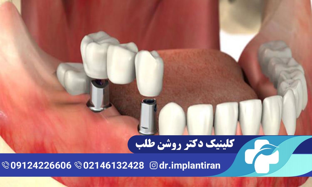 جراحی لثه برای ایمپلنت