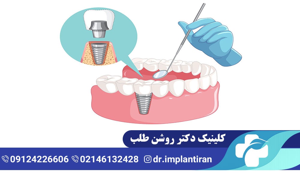 جراحی لثه برای ایمپلنت