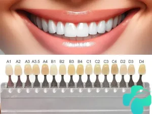 رنگ تاج ایمپلنت دندان