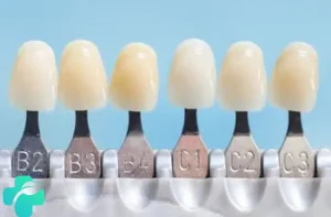 رنگ تاج ایمپلنت دندان