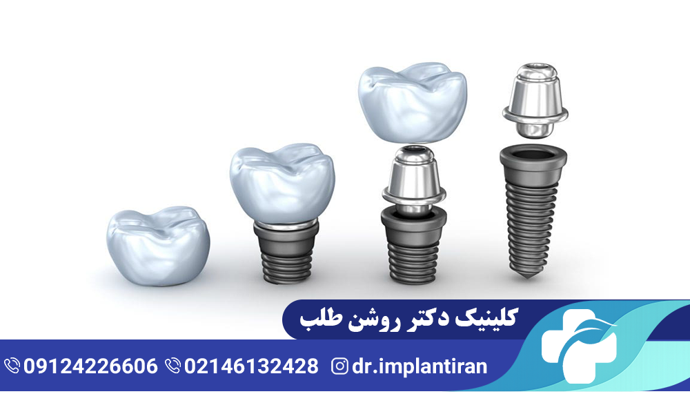 فیکسچر ایمپلنت چیست و چه کاربردی دارد؟
