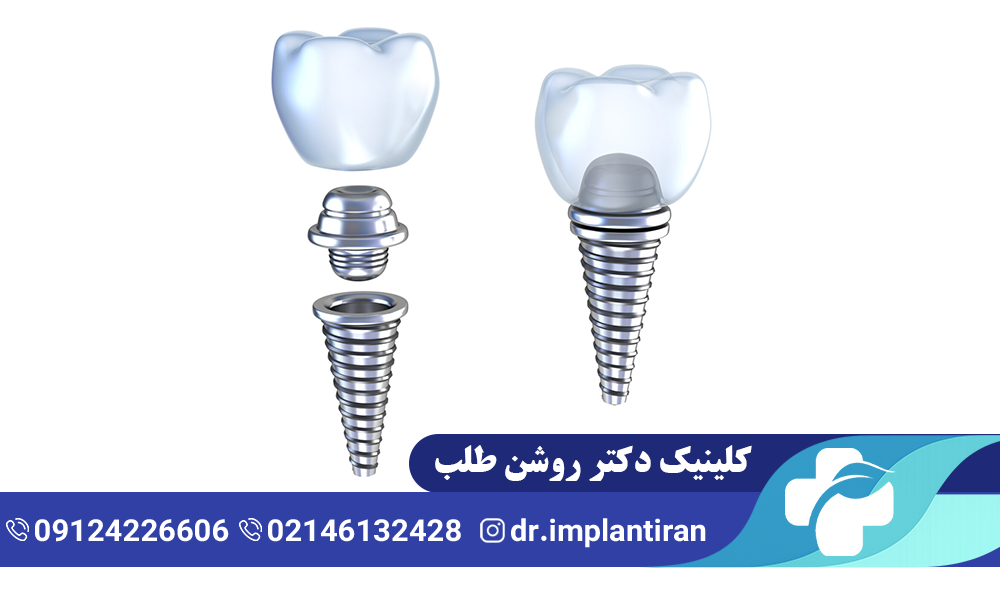 فیکسچر ایمپلنت چیست و چه کاربردی دارد؟
