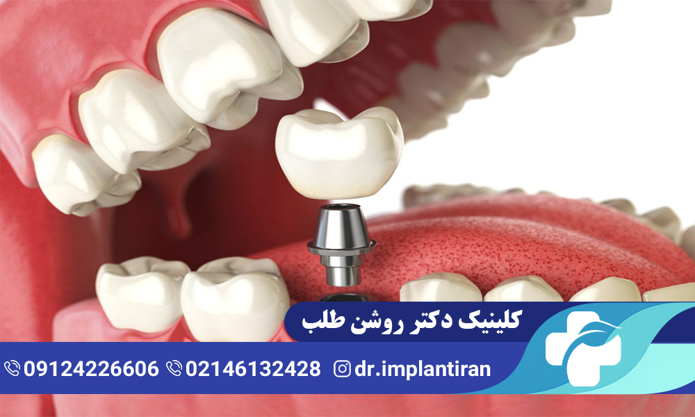 فیکسچر ایمپلنت چیست و چه کاربردی دارد؟