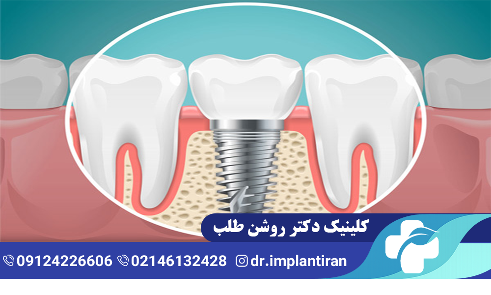 فیکسچر ایمپلنت چیست و چه کاربردی دارد؟