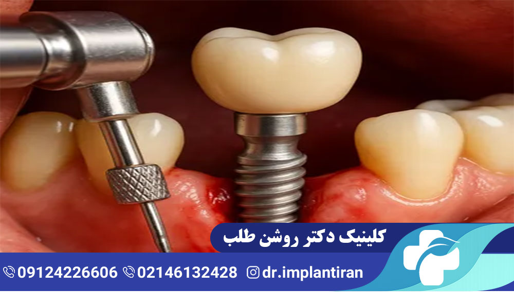 ایمپلنت بدون جراحی