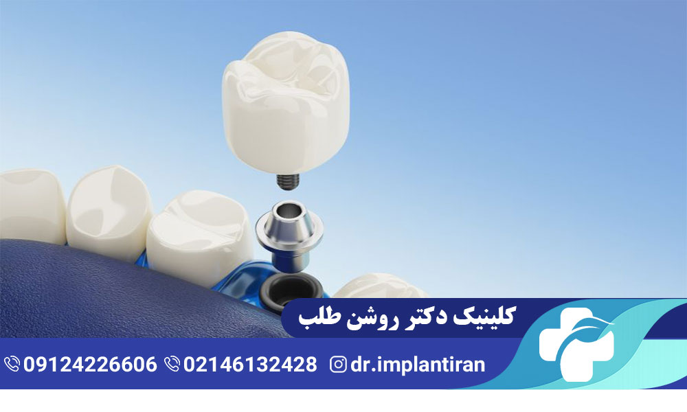 ایمپلنت بدون جراحی