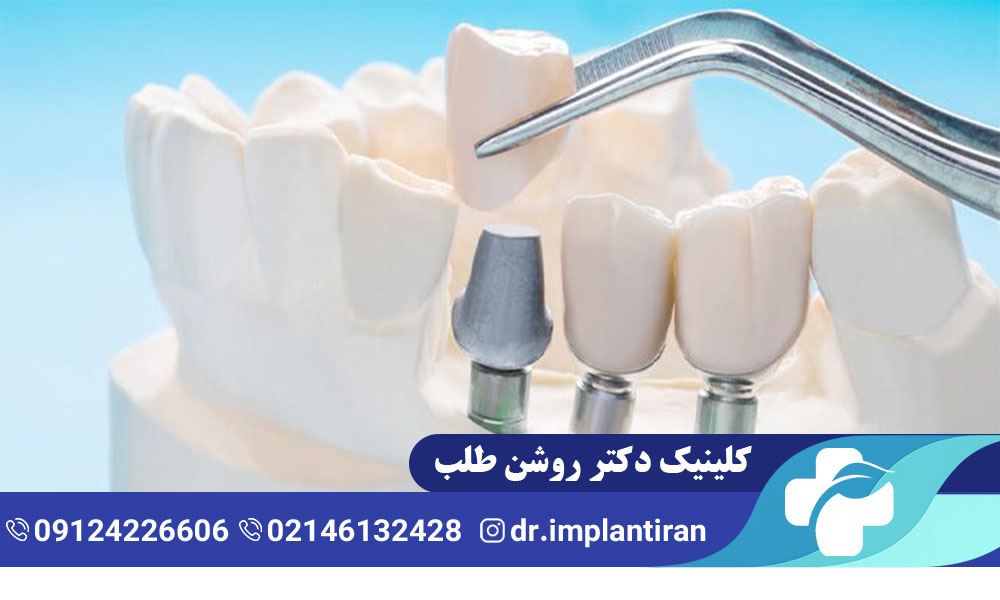 ایمپلنت بدون جراحی