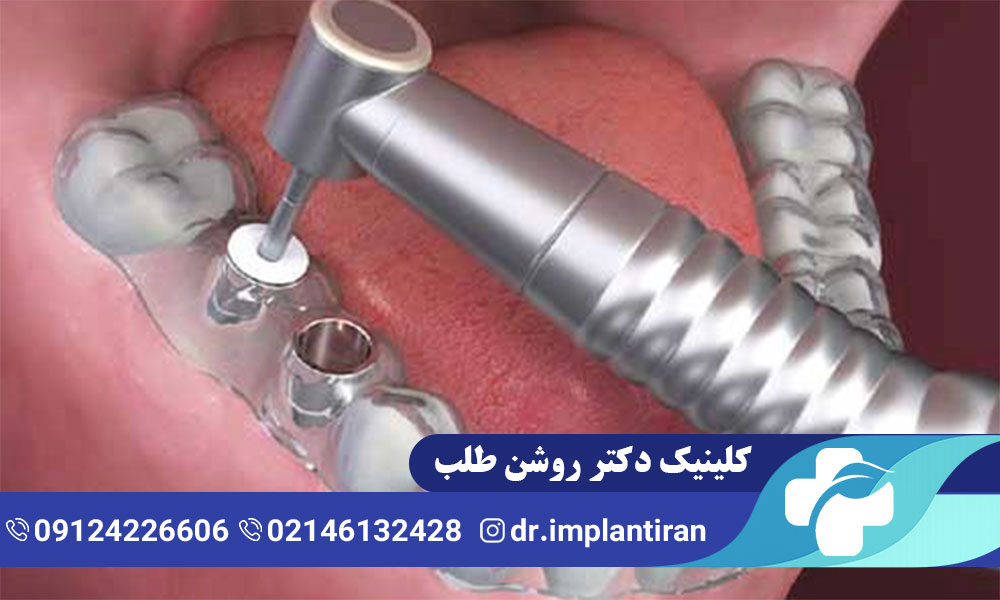 ایمپلنت بدون جراحی