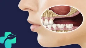 مراقبت های بعد از جراحی سینوس لیفت