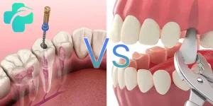 عصب کشی یا کشیدن دندان