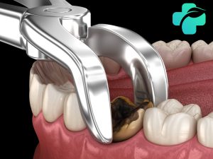 عصب کشی یا کشیدن دندان