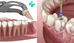عصب کشی یا کشیدن دندان