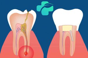 درد دندان بعد از عصب کشی