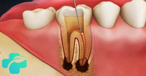 درد دندان بعد از عصب کشی