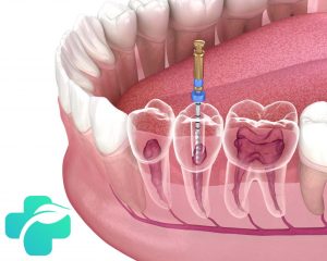 درد دندان بعد از عصب کشی